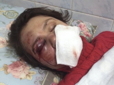 Побили журналістку та активістку Євромайдану Тетяну Чорновіл. Фото